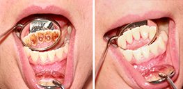 Dental Scaling | Dent Smile