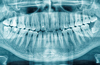 Embedded Teeth | Dent Smile