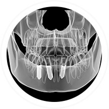 Zahnimplantate | Dent Smile