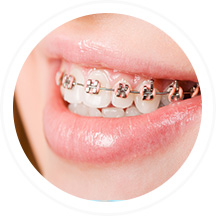 Orthodontics | Dent Smile