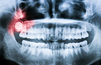 Wisdom Teeth | Dent Smile