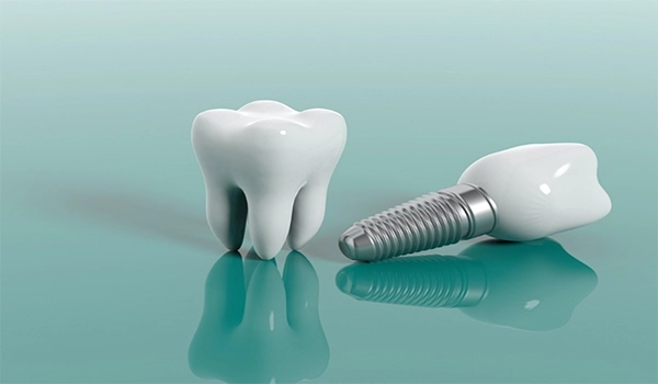 Dental Implants Costs Turkey