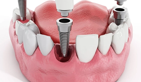 Dental Implants Costs