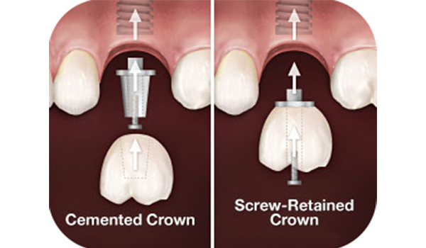 SPECILIATIES OF CEMENTATION AND SCREW-RETAINED TECHNIC FOR IMPLANT CROWNS