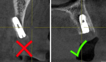 3D Dental Tomografi ile İmplant Tedavisi