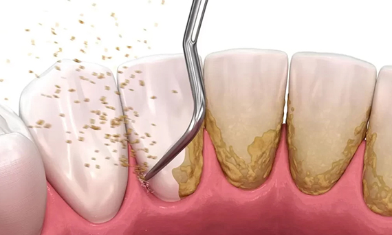 Periodontoloji (Diş Eti Hastalıkları)