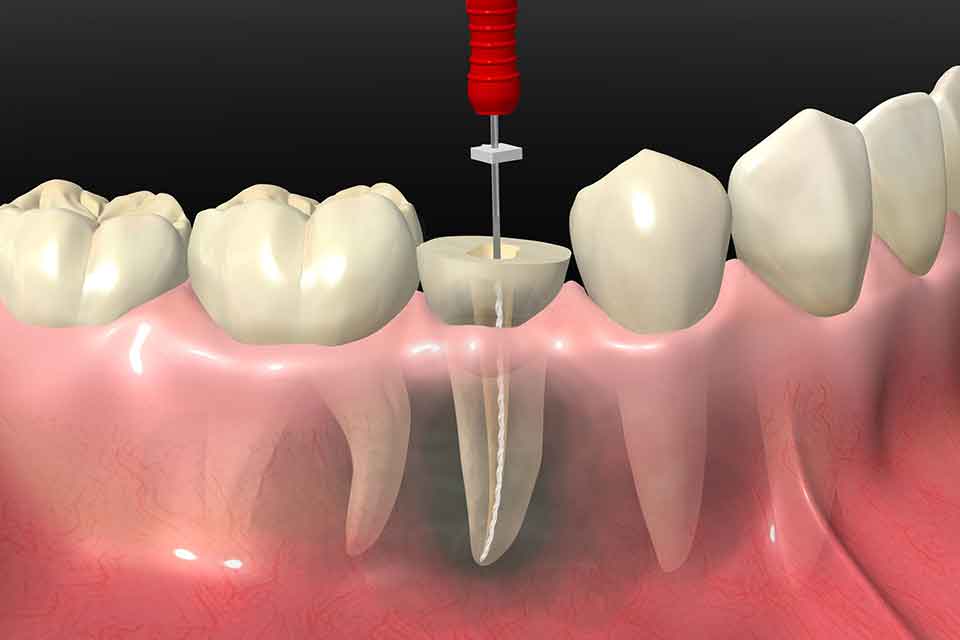 Endodonti (Kanal Tedavisi)