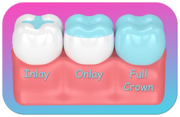 dental inlay onlay full crown small
